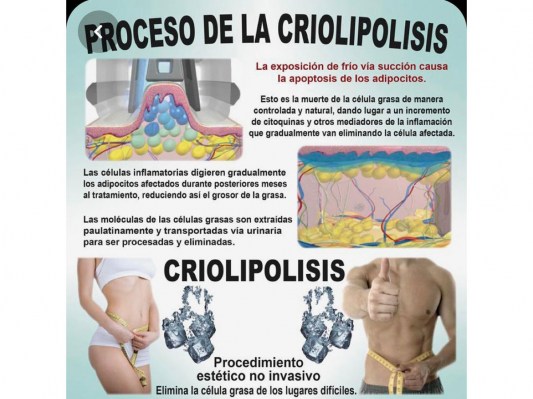 001-criolipolisis